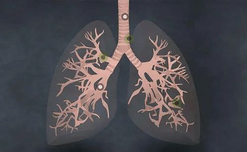 慢阻肺的pg电子平台症状(图1)